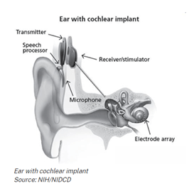 Medical drawing of an ear cochlear implant